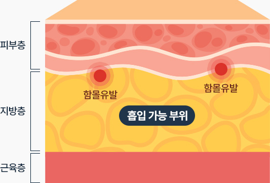 이중턱 지방흡입 흡입가능부위 지방층 과한지방흡입 시 함몰유발