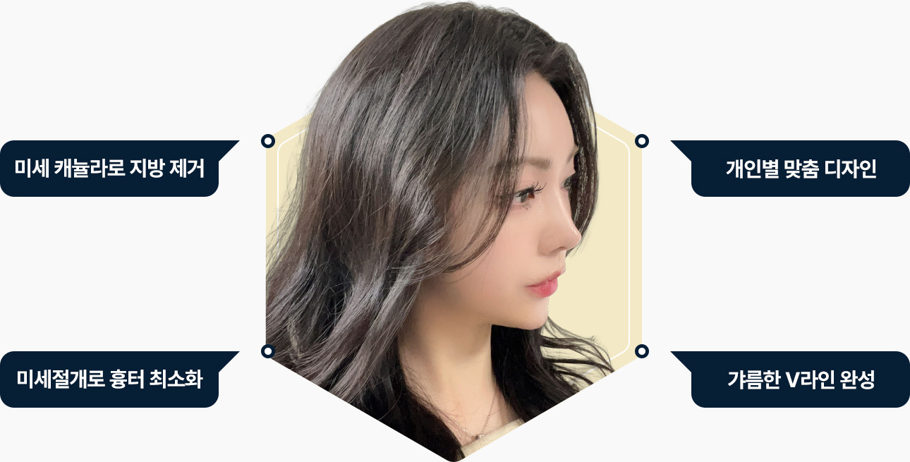 이증턱근육묶기 미세캐뉼라로 지방제거 개인별 맞춤디자인 미세절개 흉터최소 갸름한 V라인 완성