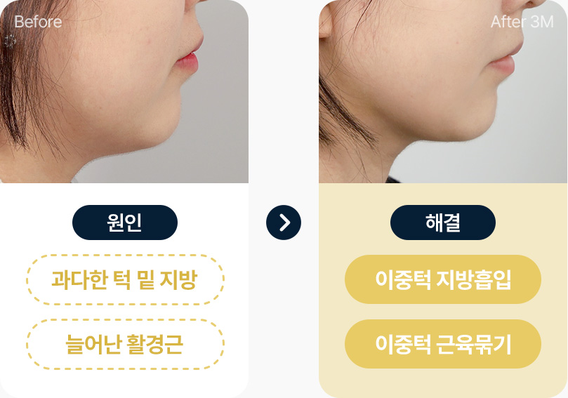 이중턱 근육묶기 원인 과다한 턱밑 지방 늘어난 활경근 해결 이중턱 지방흡입 이중턱 근육묶기