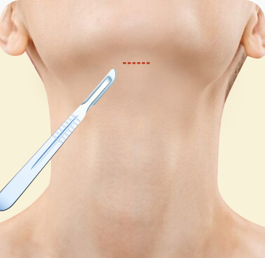 이중턱근육묶기 수술방법 턱밑 최소절개