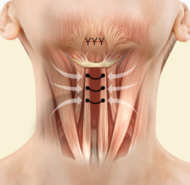 이중턱근육묶기 수술방법 활경근을 가운데로 모아 근육을 묶어 처짐방지