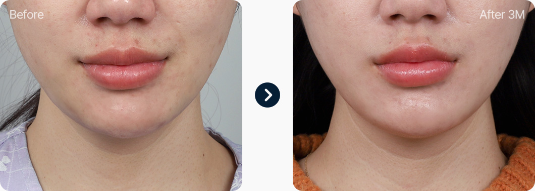 이중턱근육묶기 전후사진 이중턱근육묶기 후기 3개월후