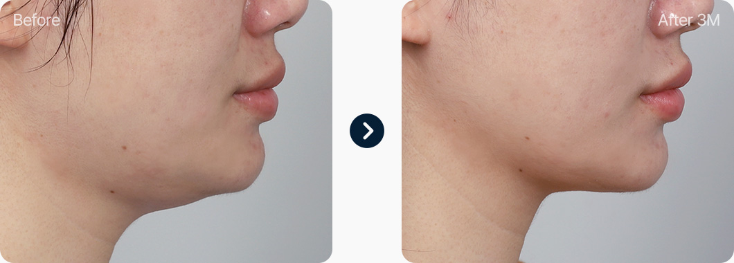 이중턱근육묶기 전후사진 이중턱근육묶기 후기 3개월후