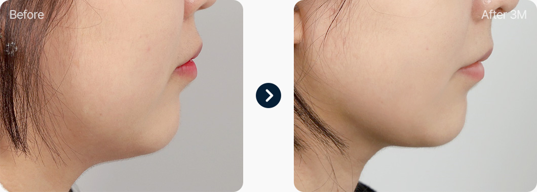 이중턱근육묶기 전후사진 이중턱근육묶기 후기 3개월후