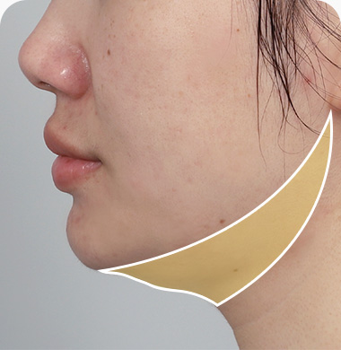 이중턱 근육묶기 추천케이스 2번 투턱 