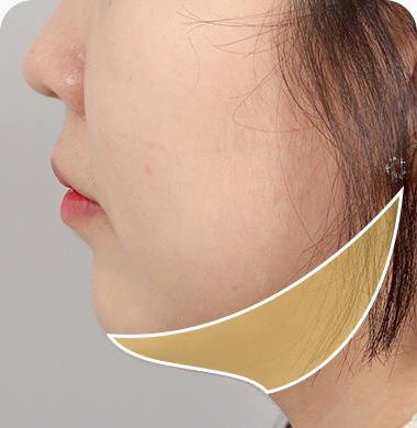 이중턱 근육묶기 추천케이스 3번 닭벼슬 모양 이중턱