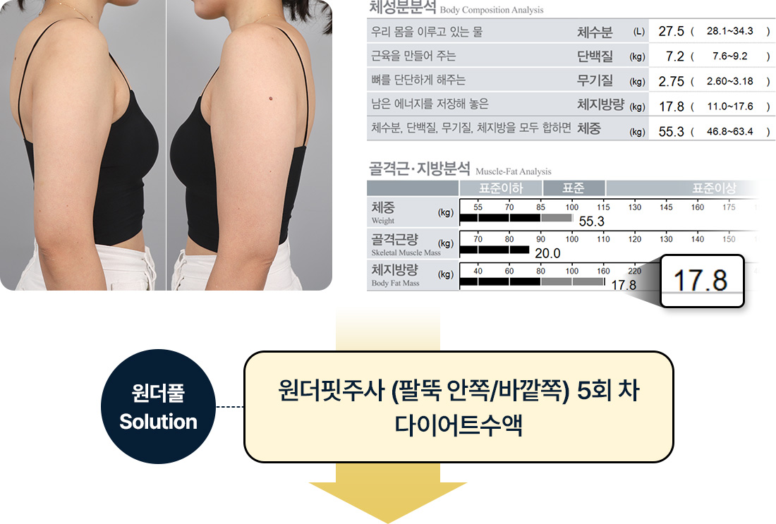 원더핏주사(바디) 지방분해주사 시술 전 후기 인바디분석 체지방 17.8