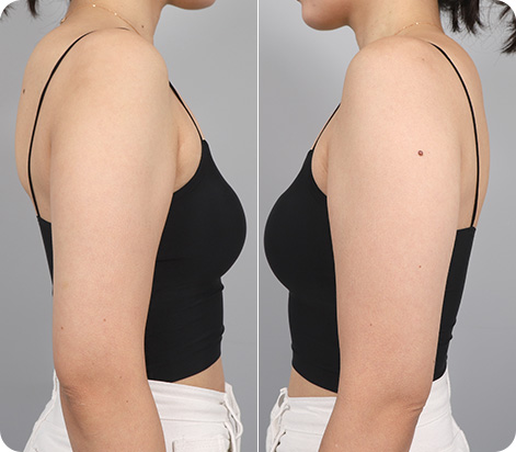 원더핏주사(바디) 지방분해주사