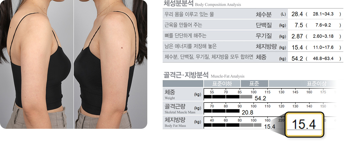 원더핏주사(바디) 지방분해주사 시술 후 후기 인바디분석 체지방 15.4