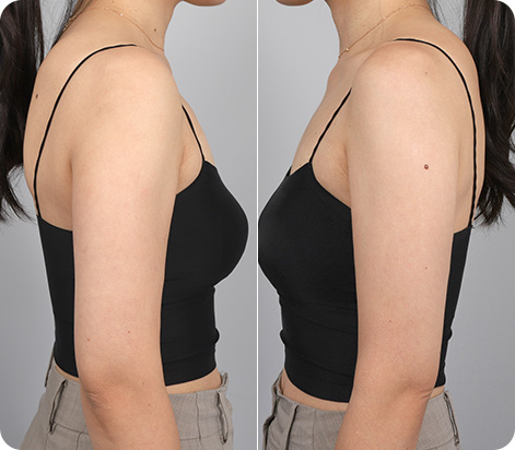 원더핏주사(바디) 지방분해주사 시술 후 후기