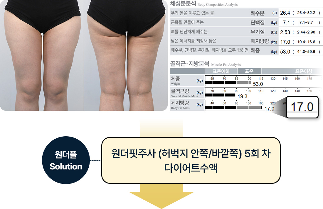 원더핏주사(바디) 지방분해주사 시술 전 후기 인바디분석 체지방 17.0