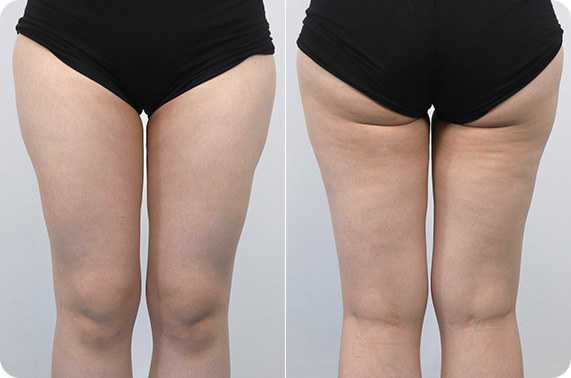 원더핏주사(바디) 지방분해주사