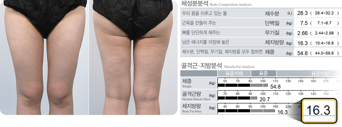 원더핏주사(바디) 지방분해주사 시술 후 후기 인바디분석 체지방 16.3