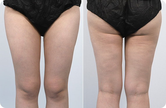 원더핏주사(바디) 지방분해주사 시술 후 후기