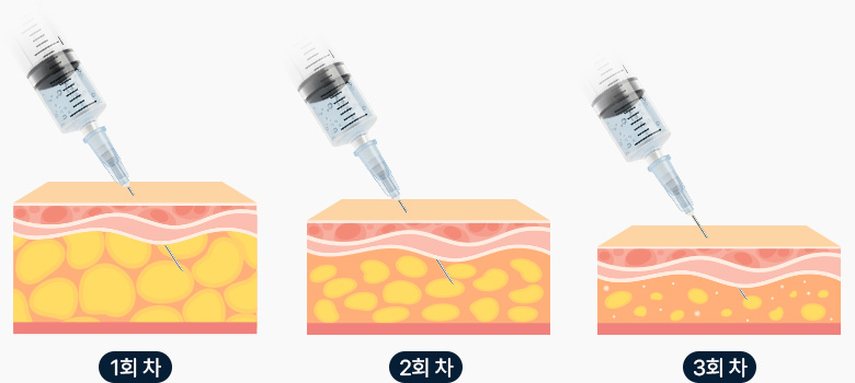 원더핏주사(바디) 지방분해주사 다회차 진행 시 지방세포 제거