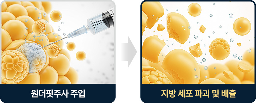  지방분해주사 원더핏주사(얼굴) 절개부위 귓볼뒤 턱밑