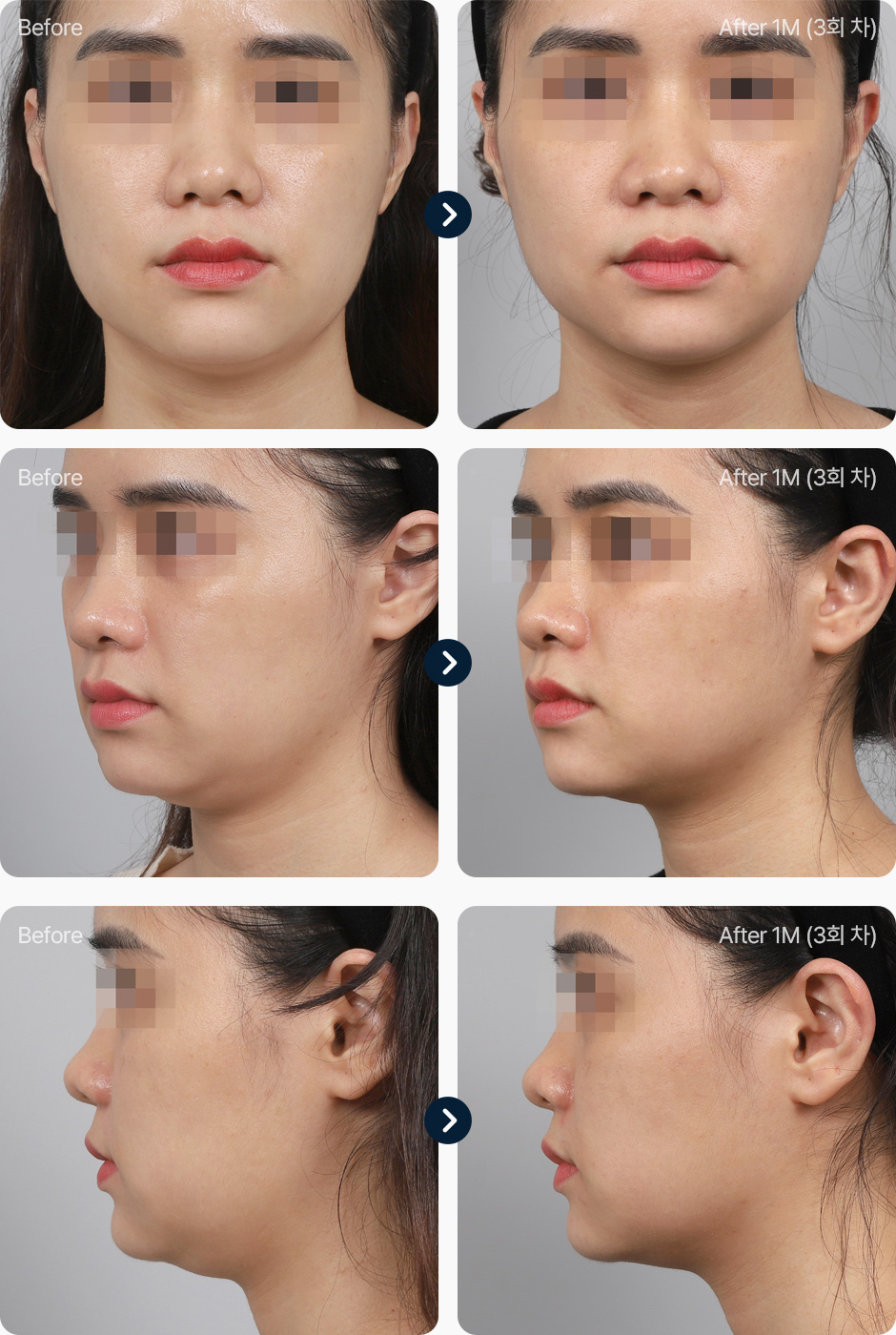 원더핏주사(얼굴) 지방분해주사 전후사진 원더핏주사 후기 1개월후 3회차