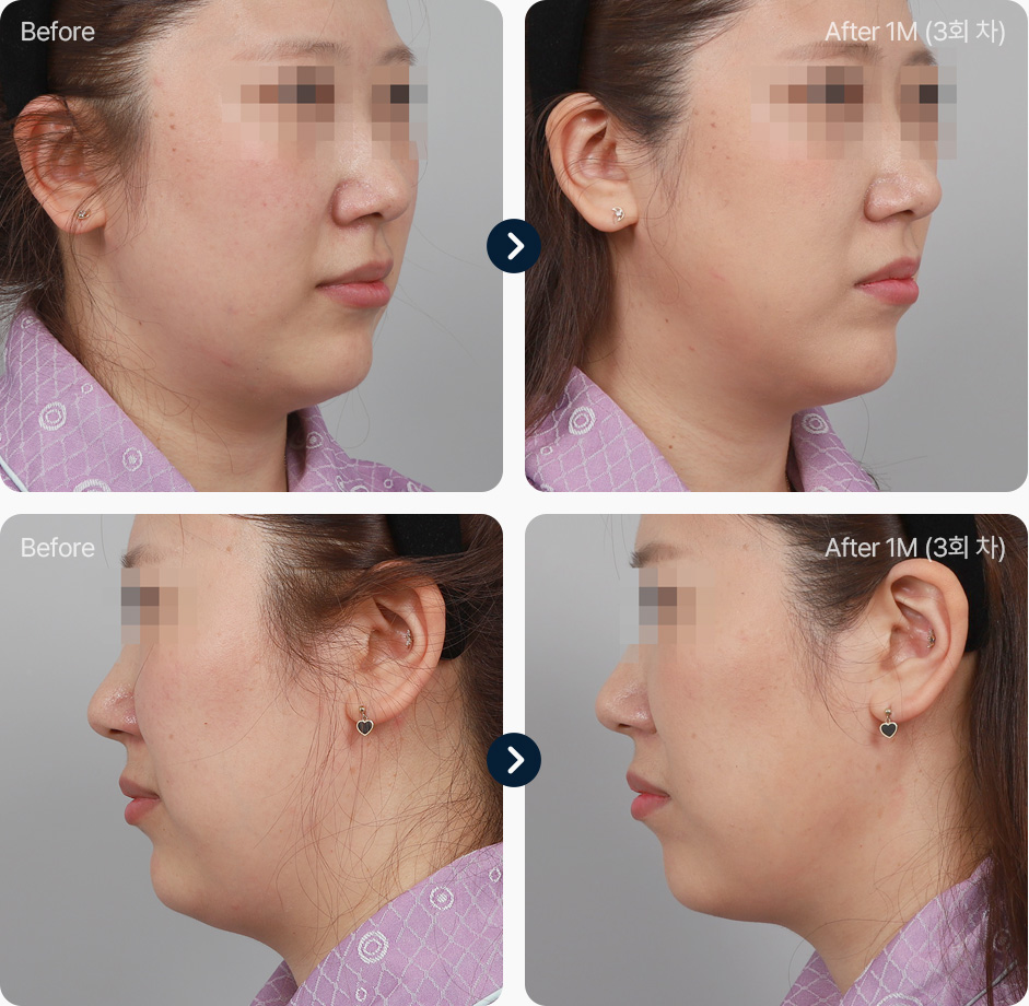 원더핏주사(얼굴) 지방분해주사 전후사진 원더핏주사 후기 1개월후 3회차