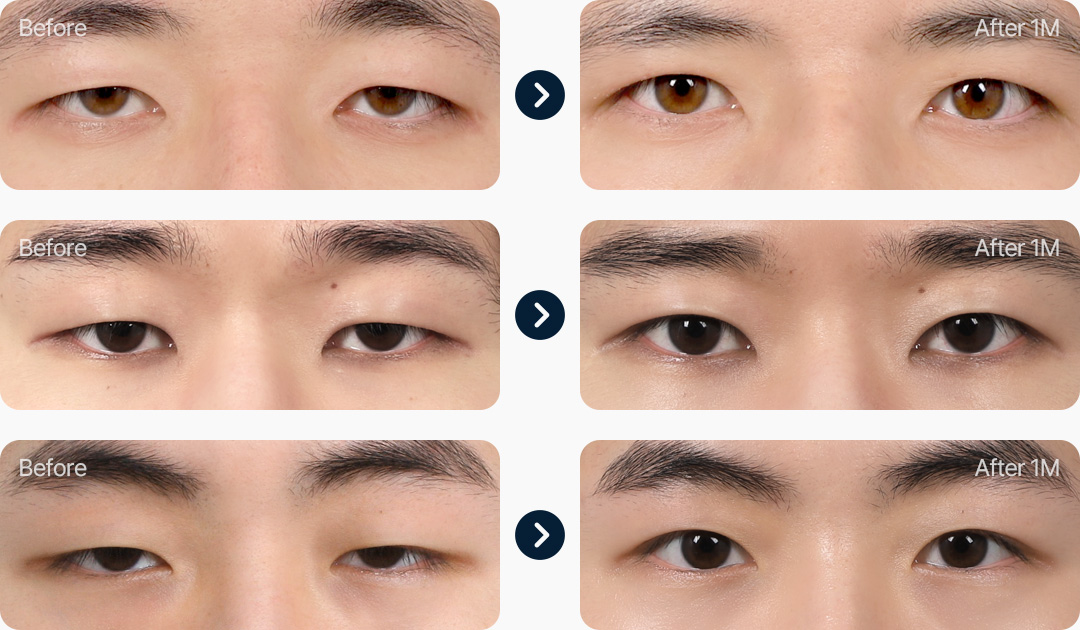 눈매교정 전후사진