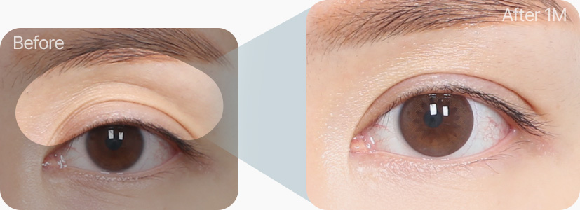 눈위지방이식 전후사진