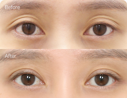 눈위지방이식 전후사진