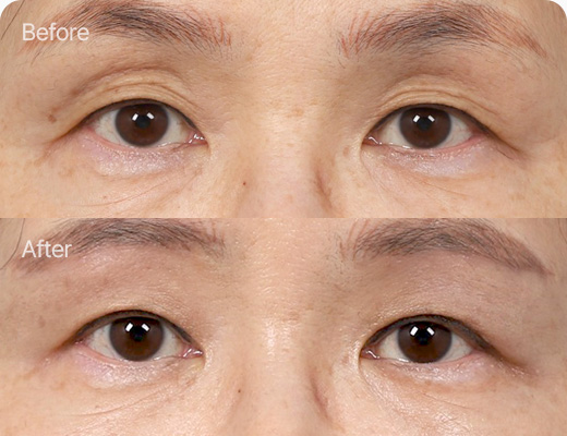 눈위지방이식 전후사진