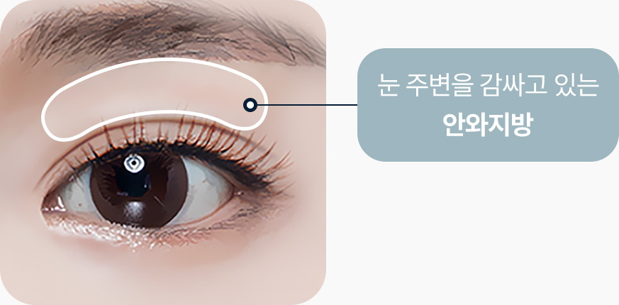 눈꺼풀 지방제거 눈주변을 감싸고있는 안와지방