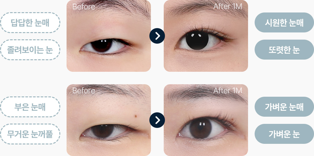 눈꺼풀지방제거 전후사진 시원한 눈매 또렷한 눈 가벼운 눈