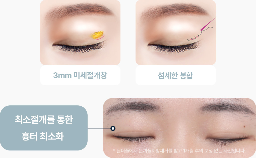 눈꺼풀 지방제거 최소절개 3mm 미세절개창 섬세한 봉합 흉터 최소화