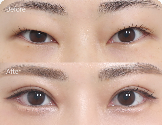 눈꺼풀지방제거 전후사진