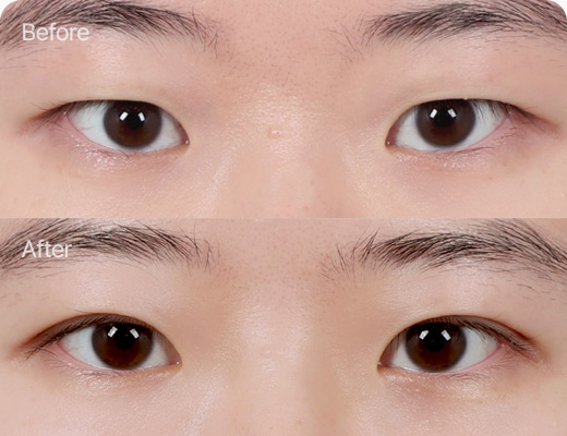눈꺼풀지방제거 전후사진