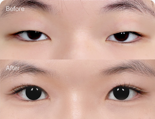 눈꺼풀지방제거 전후사진