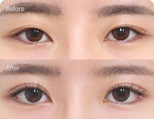 눈꺼풀지방제거 전후사진