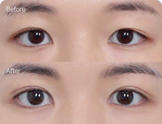 눈꺼풀지방제거 전후사진
