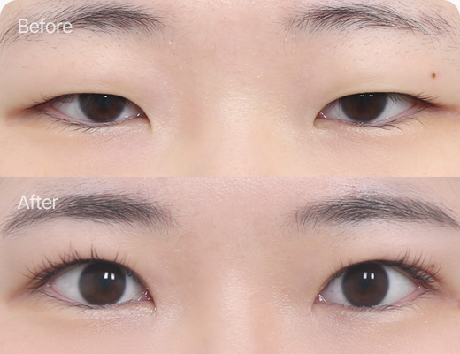 눈꺼풀지방제거 전후사진