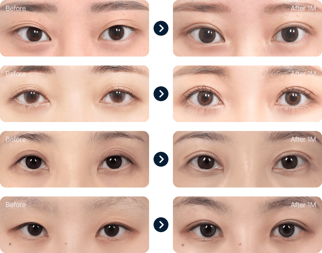 눈재수술 전후사진