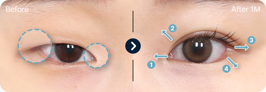 트임 전후사진 크고 시원한 눈매