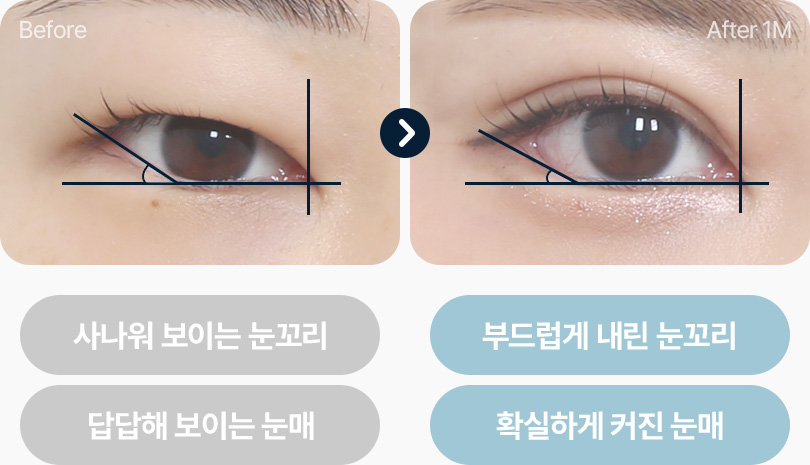 눈 비율을 살린 맞춤형 트임 부드럽게 내린 눈꼬리 큰 눈매 트임 전후사진