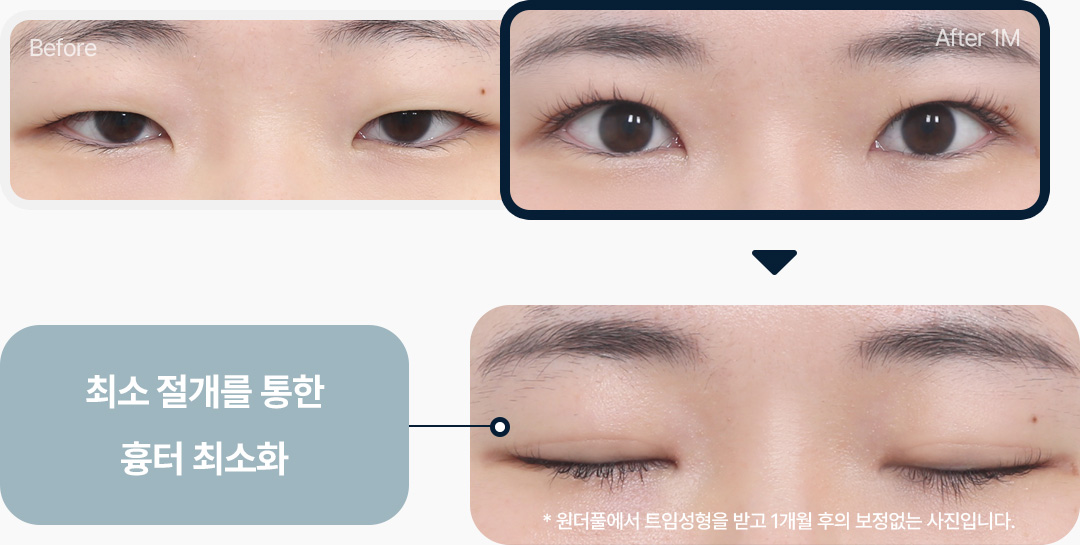 최소절개 흉터 최소화 앞트임 윗트임 전후사진 1개월