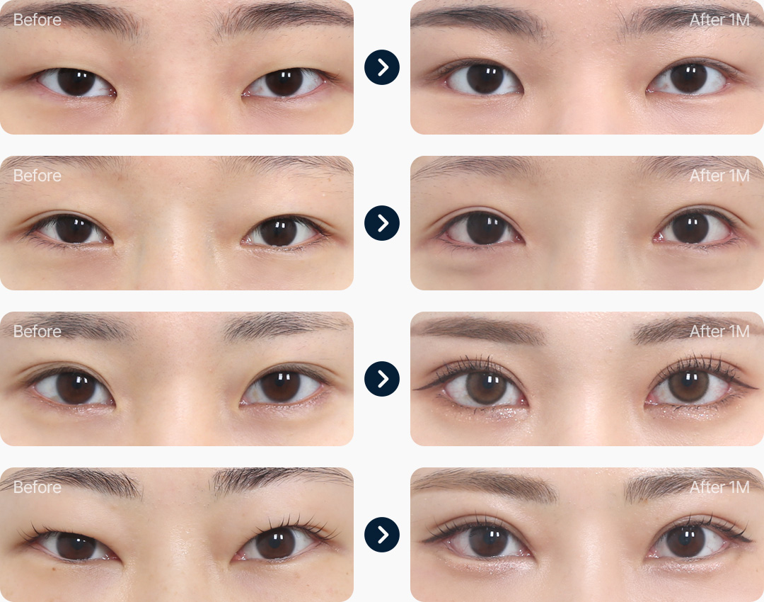 뒤밑트임 뒤트임 밑트임 전후사진