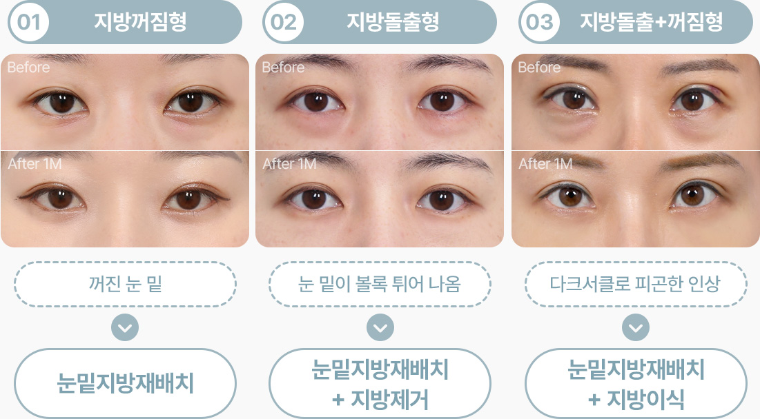 지방꺼짐형 눈밑지방재배치 지방돌출형 눈밑지방재배치+지방제거 지방돌출+꺼짐형 다크써클 눈밑지방재배치+지방이식