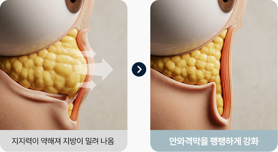 안와격막이 약해지며 늘어짐 안와격막 고정 팽팽하게 강화