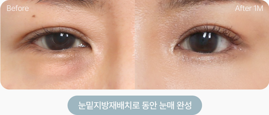 눈밑지방재배치로 동안 눈매