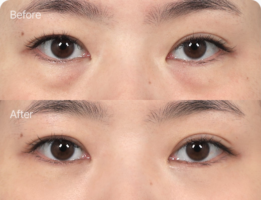 눈밑지방재배치 전후사진