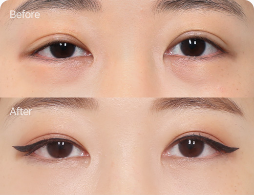 눈밑지방재배치 전후사진