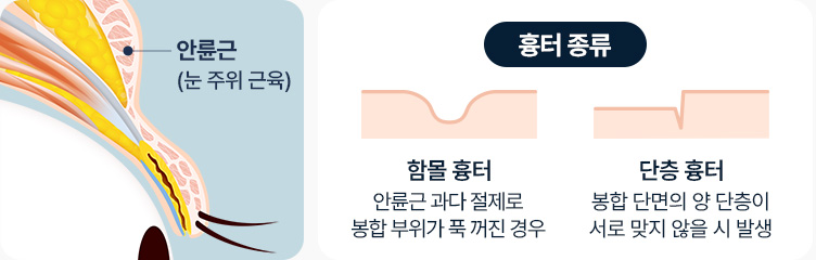 원더풀 라인낮추기 두줄따기 노하우 숙련된 의료진 고난이도 재수술 눈재수술