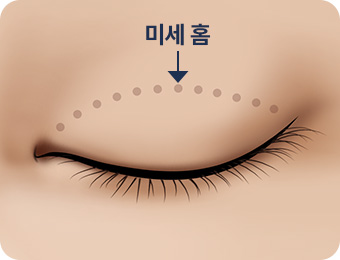 원더풀 자연유착 미세홈