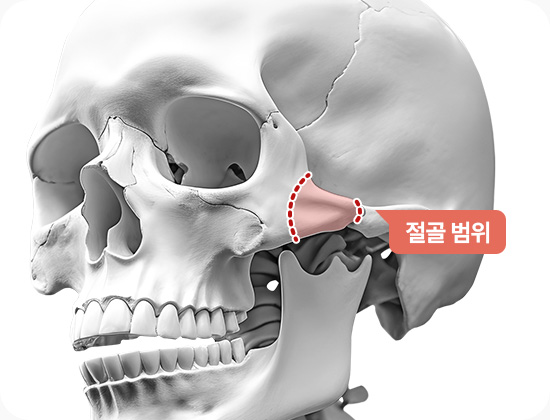 광대축소 처짐방지 광대 절골 범위 45도 광대 뒷광대 절골