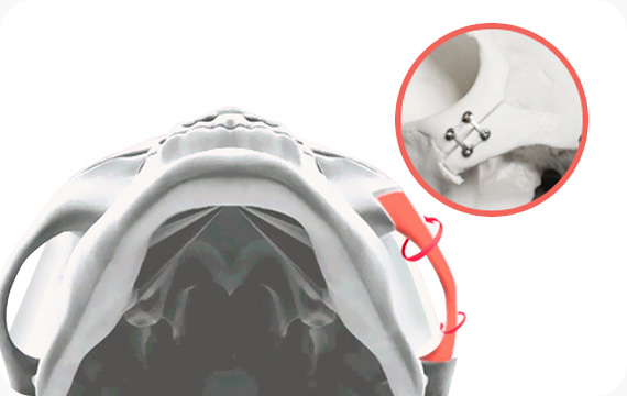 광대축소 절골 후 플레이트와 와이어를 이용한 이중고정