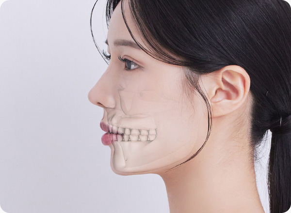 사각턱수술 하악각 브이라인 갸름한 얼굴라인